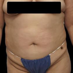 Tummy Tuck Before & After Patient #1705