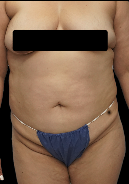 Tummy Tuck Before & After Patient #1705