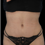 Tummy Tuck Before & After Patient #1705