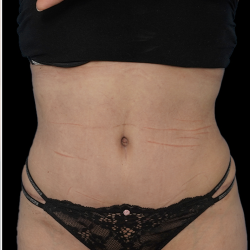 Tummy Tuck Before & After Patient #1705