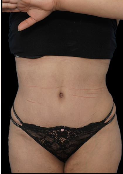 Tummy Tuck Before & After Patient #1705