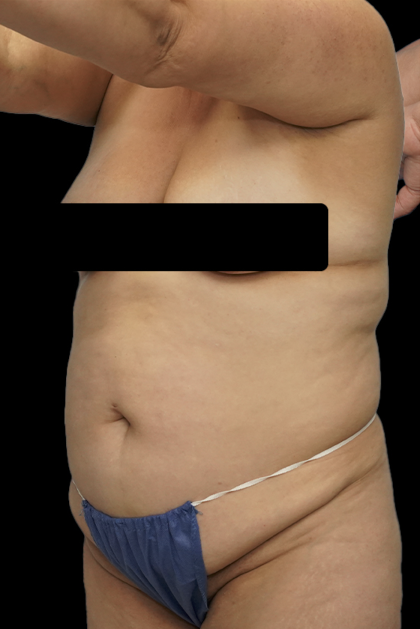 Tummy Tuck Before & After Patient #1705