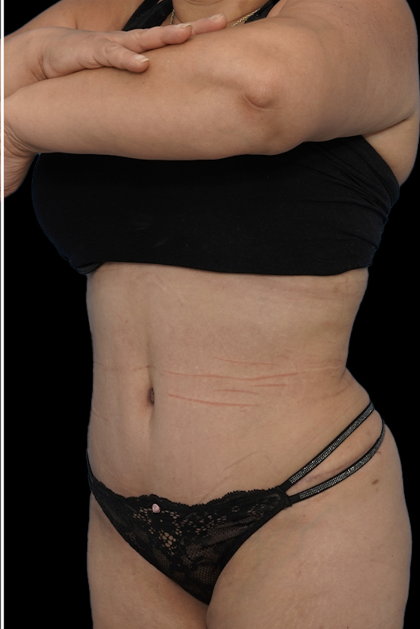 Tummy Tuck Before & After Patient #1705