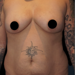 Tummy Tuck Before & After Patient #1706