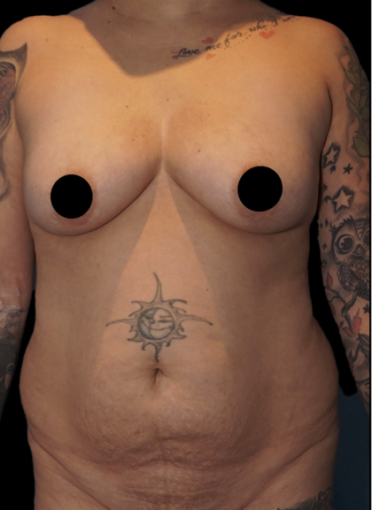 Tummy Tuck Before & After Patient #1706