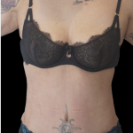Tummy Tuck Before & After Patient #1706