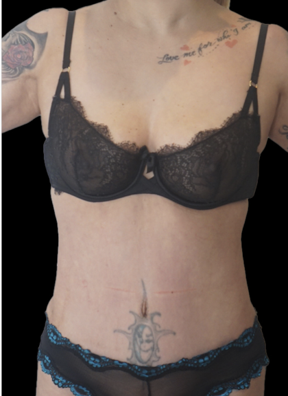 Tummy Tuck Before & After Patient #1706