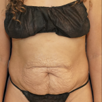 Tummy Tuck Before & After Patient #1707