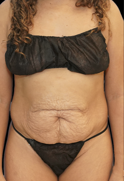 Tummy Tuck Before & After Patient #1707