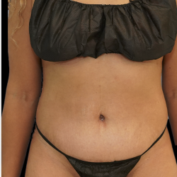 Tummy Tuck Before & After Patient #1707