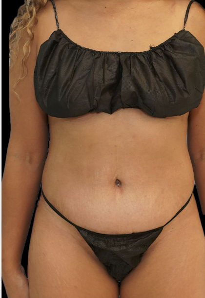Tummy Tuck Before & After Patient #1707
