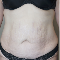 Tummy Tuck Before & After Patient #1708