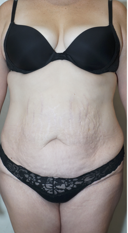 Tummy Tuck Before & After Patient #1708