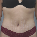 Tummy Tuck Before & After Patient #1708