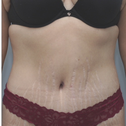 Tummy Tuck Before & After Patient #1708