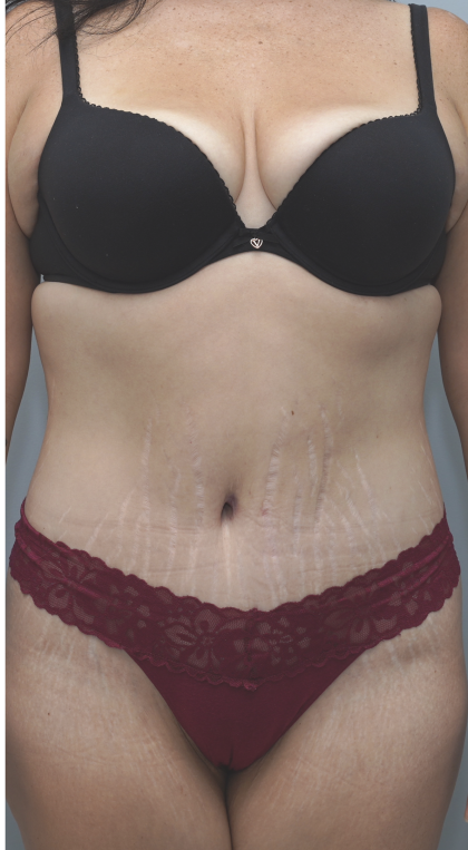 Tummy Tuck Before & After Patient #1708
