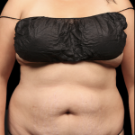 Tummy Tuck Before & After Patient #1709