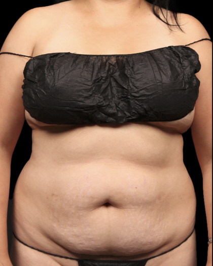 Tummy Tuck Before & After Patient #1709