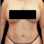 Tummy Tuck Before & After Patient #1709