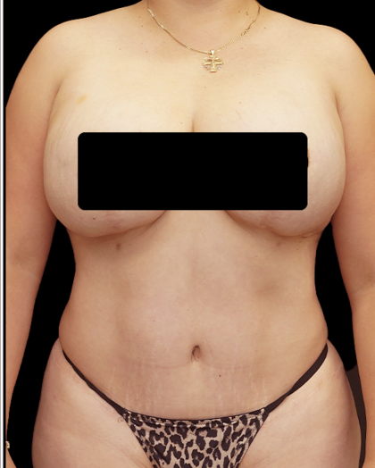 Tummy Tuck Before & After Patient #1709