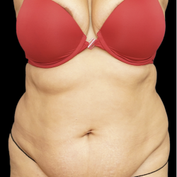 Tummy Tuck Before & After Patient #1710
