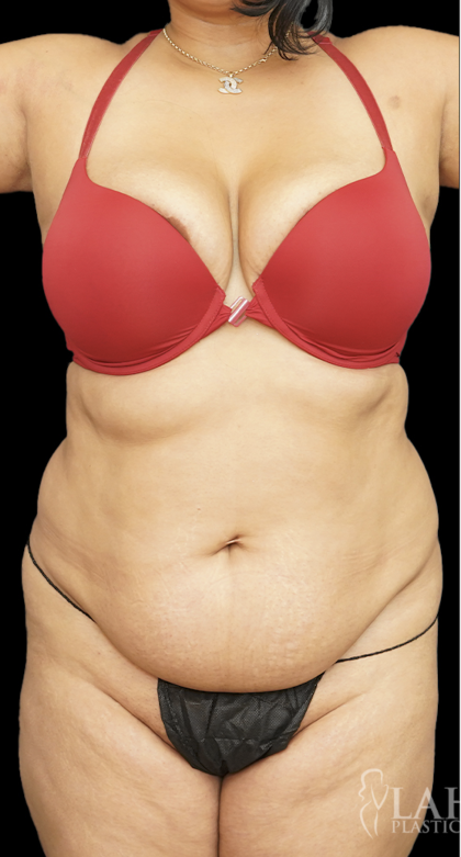 Tummy Tuck Before & After Patient #1710