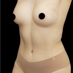 Tummy Tuck Before & After Patient #1711