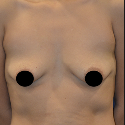 Breast Augmentation Before & After Patient #1635
