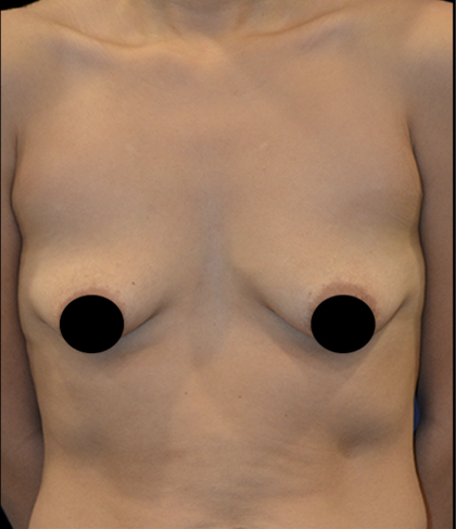 Breast Augmentation Before & After Patient #1635