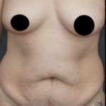 Tummy Tuck Before & After Patient #1712