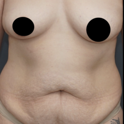 Tummy Tuck Before & After Patient #1712