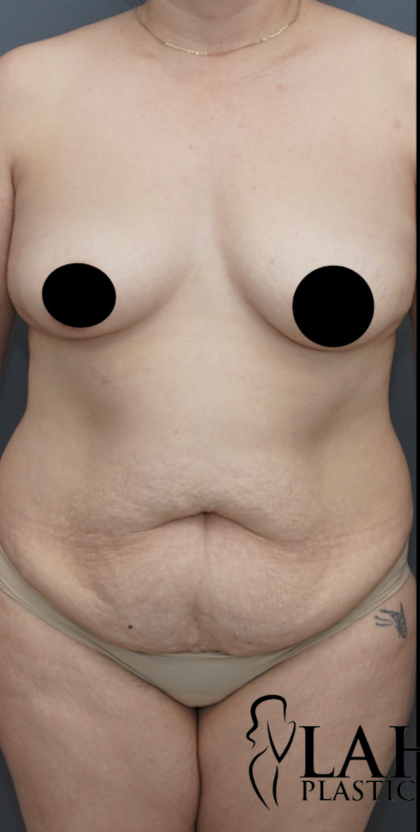 Tummy Tuck Before & After Patient #1712