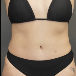 Tummy Tuck Before & After Patient #1712