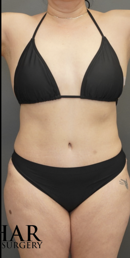 Tummy Tuck Before & After Patient #1712