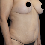 Tummy Tuck Before & After Patient #1730