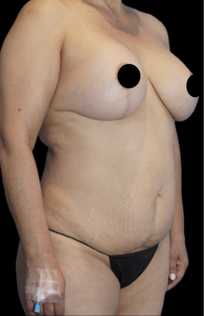 Tummy Tuck Before & After Patient #1730
