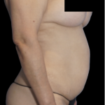 Tummy Tuck Before & After Patient #1730