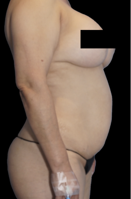 Tummy Tuck Before & After Patient #1730
