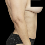 Tummy Tuck Before & After Patient #1730