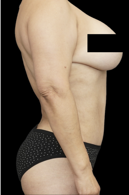 Tummy Tuck Before & After Patient #1730