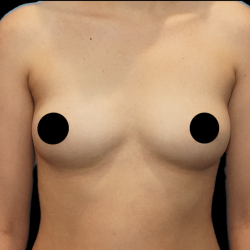 Breast Augmentation Before & After Patient #1636
