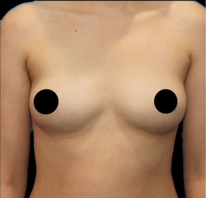 Breast Augmentation Before & After Patient #1636