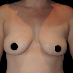 Breast Augmentation Before & After Patient #1637
