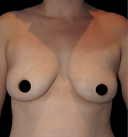 Breast Augmentation Before & After Patient #1637