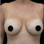 Breast Augmentation Before & After Patient #1637