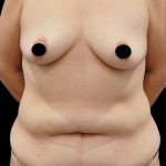 Breast Augmentation Before & After Patient #1638