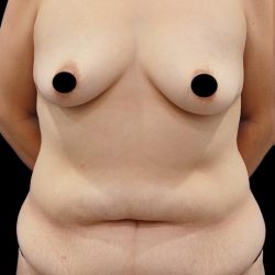 Breast Augmentation Before & After Patient #1638