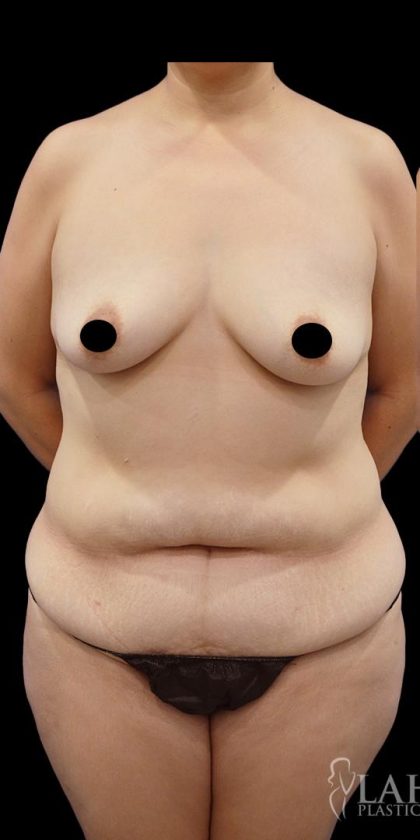 Breast Augmentation Before & After Patient #1638