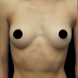 Breast Augmentation Before & After Patient #1639