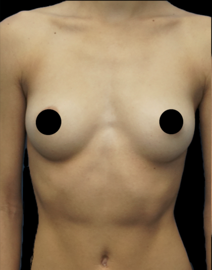 Breast Augmentation Before & After Patient #1639